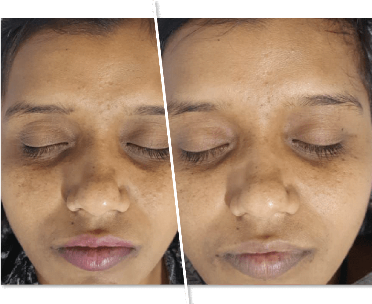 women Before After Skin Polish Treatment